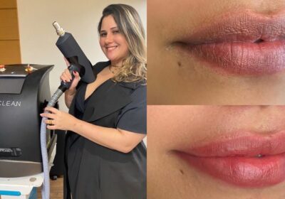 Desvendando a Remoção a Laser e a Micropigmentação: Rachel Bizzo Explica os Segredos do Processo